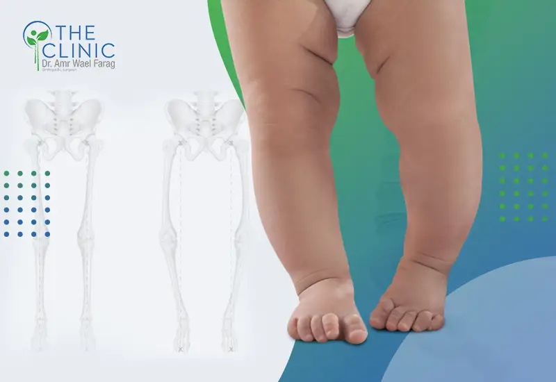 طرق علاج تقوس الساقين
