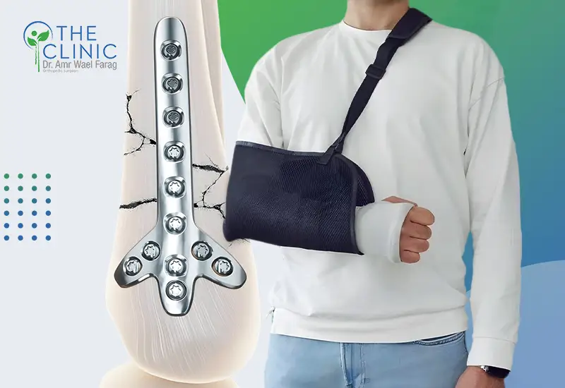 علاج كسور العظام