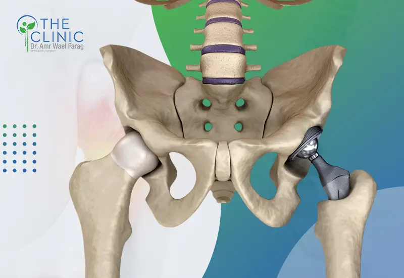 عملية تغيير مفصل الفخذ