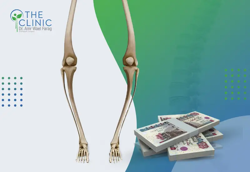 تكلفة عملية تقوس الساقين في مصر 2026