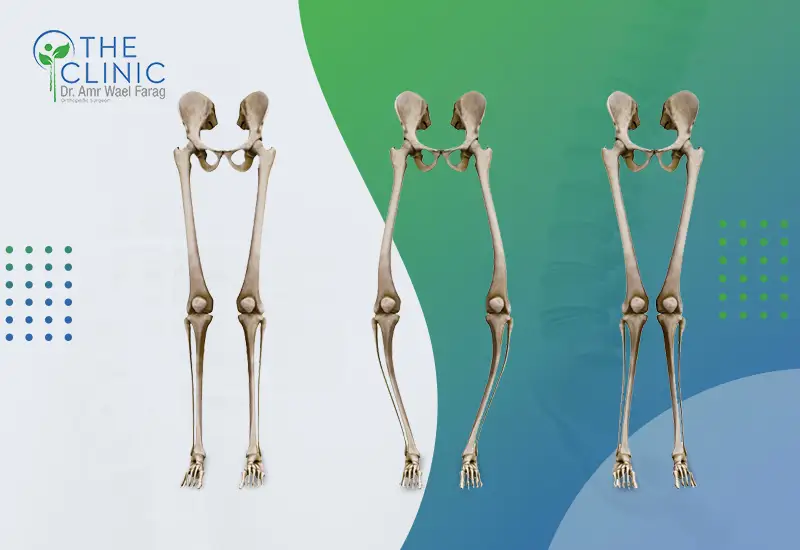 ما-هى-درجات-تقوس-الساقين درجات تقوس الساقين عند الكبار