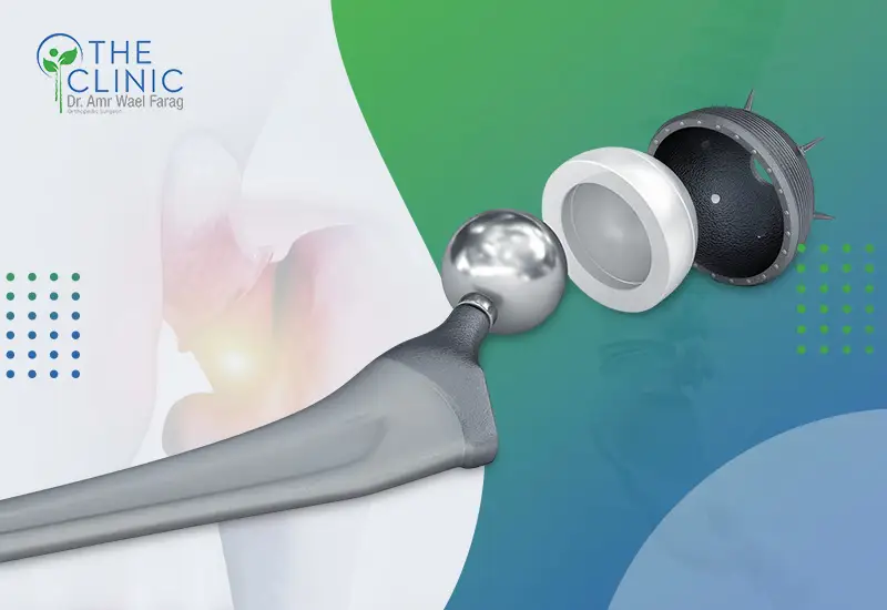 أفضل أنواع مفصل الورك الصناعي 2026