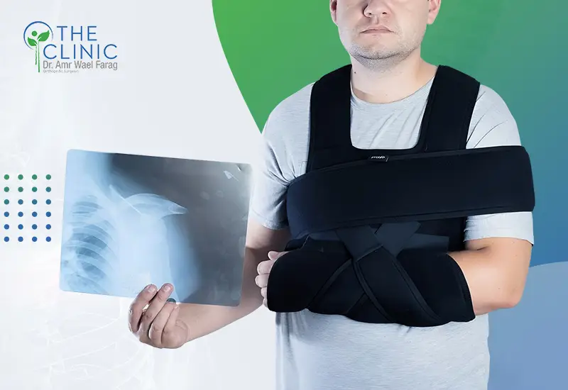 علاج كسر الترقوة